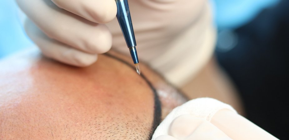 Transplantace vlasů metodou Sapphire FUE: co to je a pro koho se hodí?