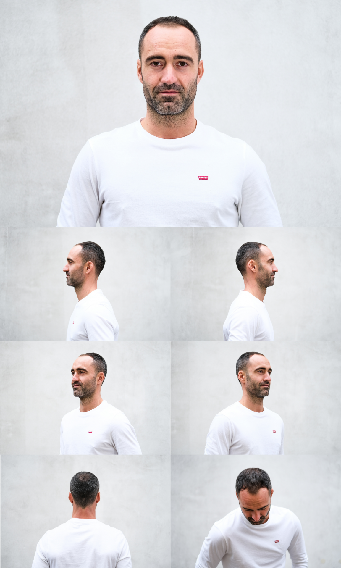 Příklad fotografií pro zhodnocení vhodnosti podstoupit transplantaci vlasů