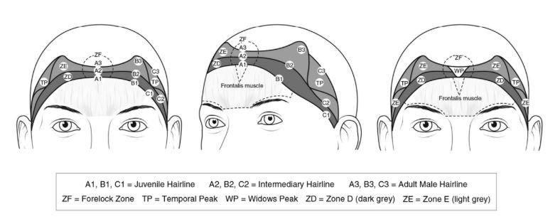 A1, B1, C1 – hranice vlasové linky u mladistvých; A3, B3, C3 – zralá vlasová linie (bez známek plešatění).
