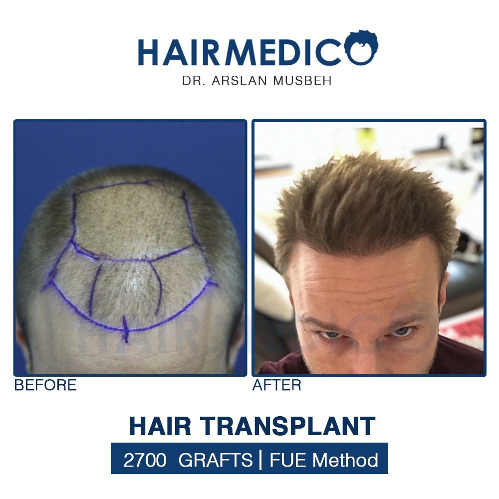 Ukázka před a po transplantaci vlasů