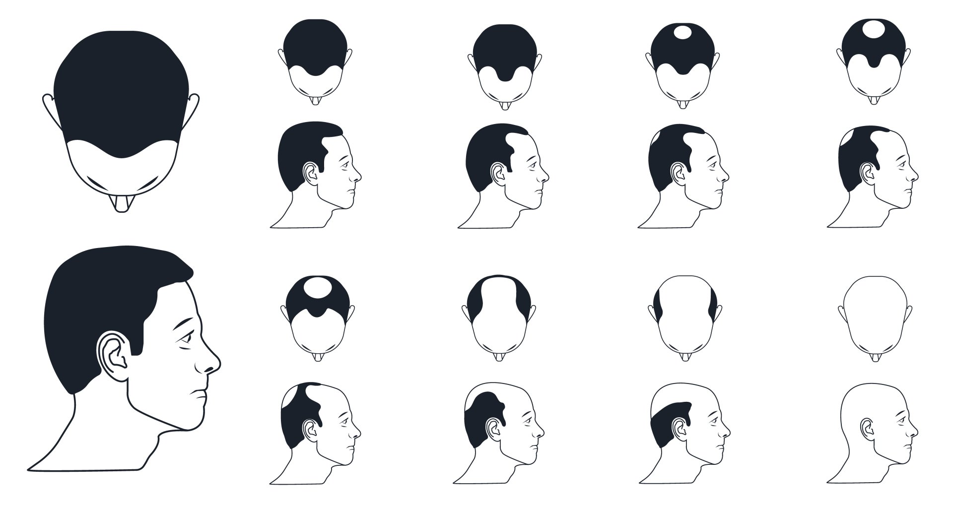 Podle míry vypadlých vlasů může dermatolog určit způsob léčby. Zdroj: wikipedia.org