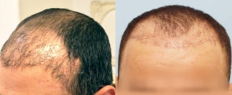 Takto řídké vlasy v oblasti transplantace jsou výsledkem masivního odumření štěpů
